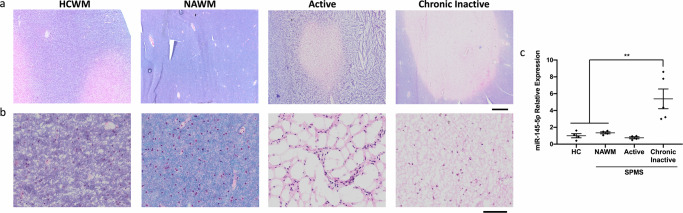 miR-145-5p is upregulated in chronic lesion tissue from SPMS brains. a, b Luxol fast blue/hematoxylin and eosin stained human brain tissue from healthy control white matter (HCWM), and normal appearing white matter (NAWM), active and chronic inactive lesion tissue from SPMS brain. a Scale bar = 1 mm. b Magnified from (a); scale bar = 50 µm.