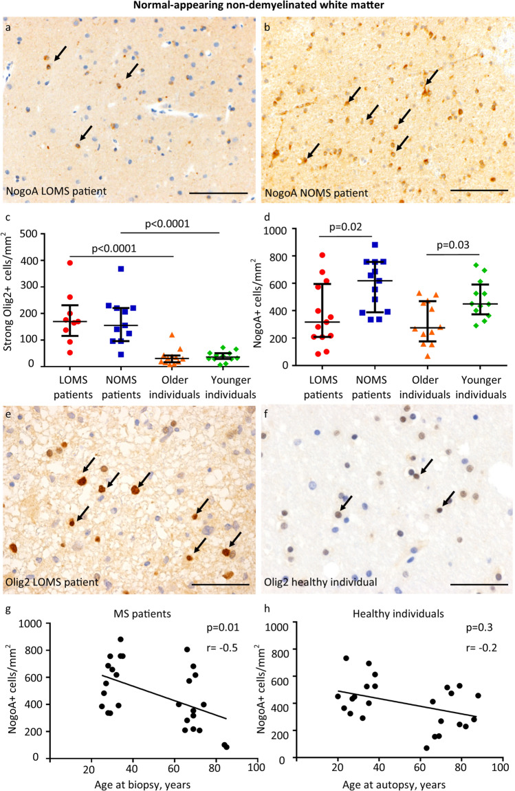 Anti-Olig2 staining of the white matter of a healthy older individual: Both strongly (arrows) and weakly Olig2-positive nuclei are identified.