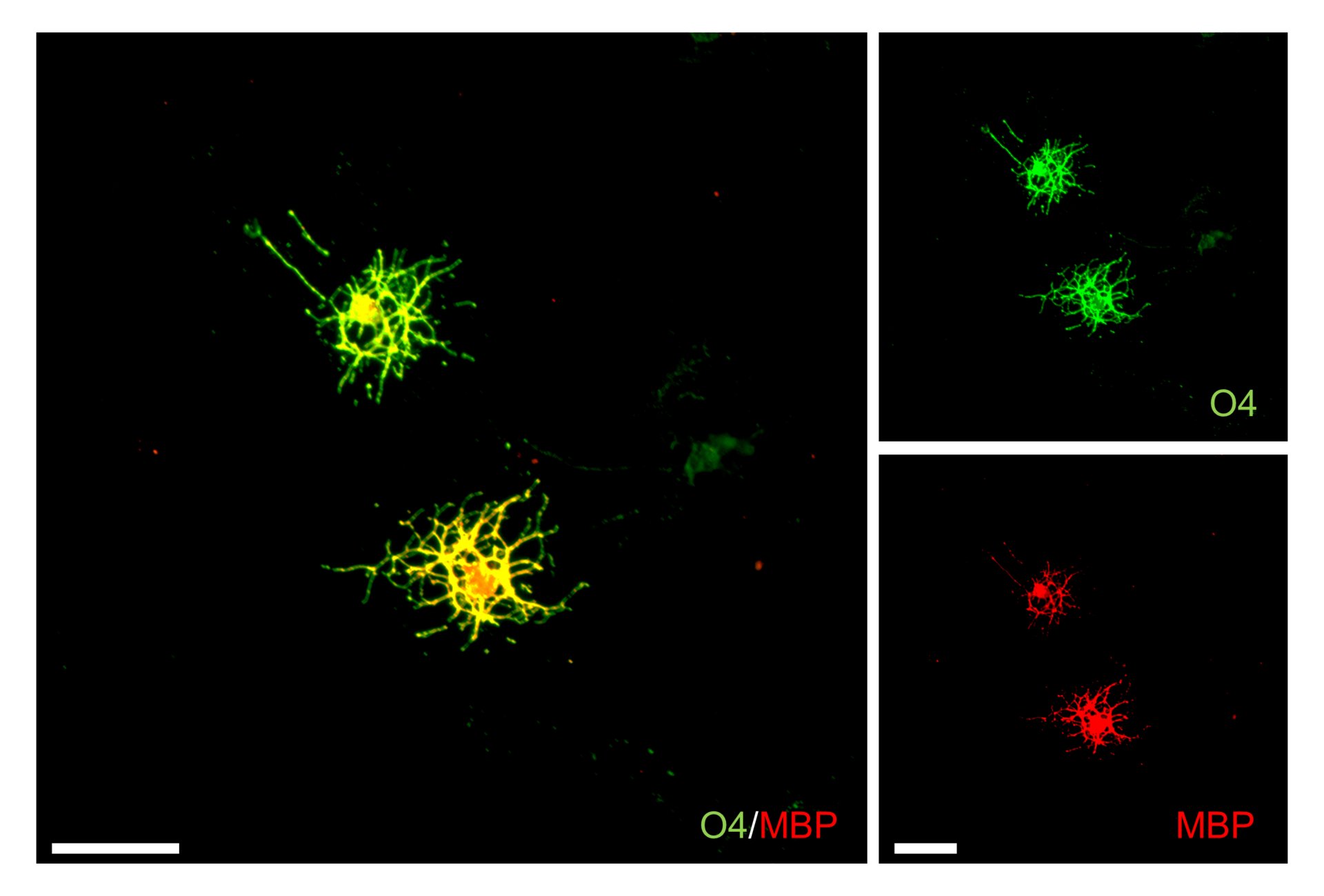 Immunofluorescence of oligodendrocytes differentiated from human iPSCs. O4 (green) marks the oligodendrocyte surface; MBP (red) marks myelin basic protein. The two markers co-localise in mature oligodendrocytes.